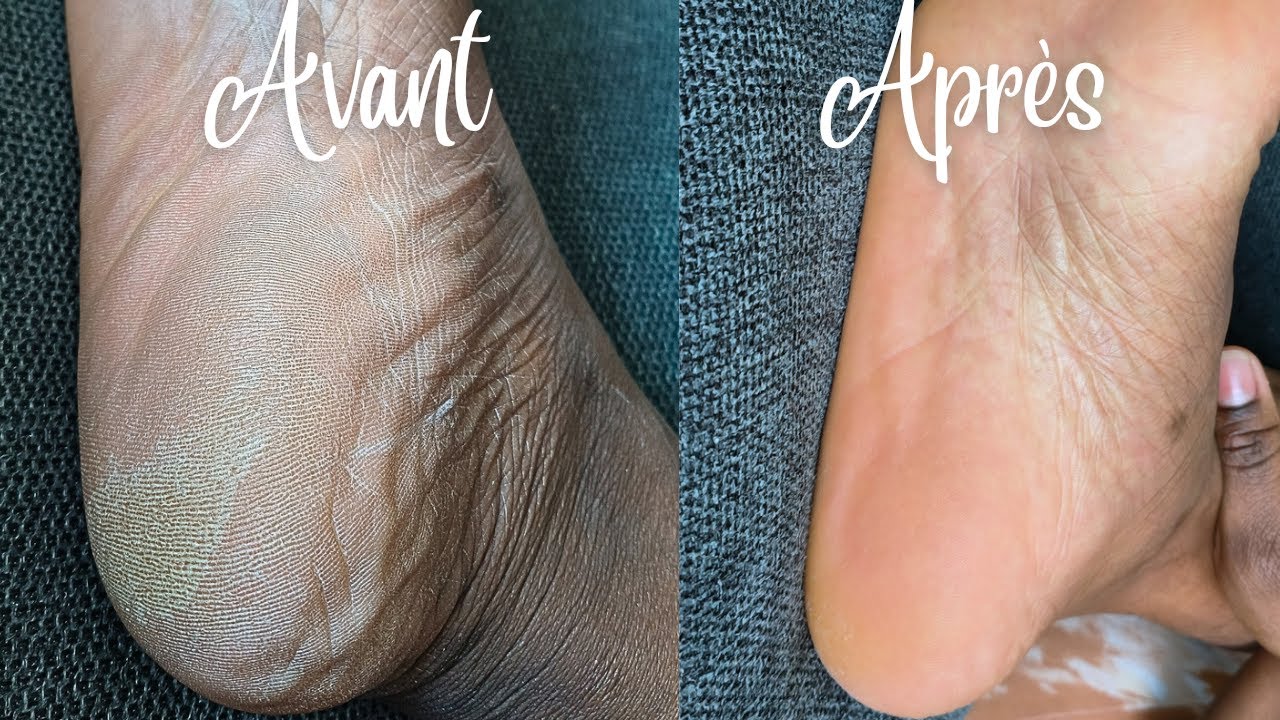 Râpe Électrique Anti-Callosités – Pour des pieds doux et lisses en un instant - Ma boutique